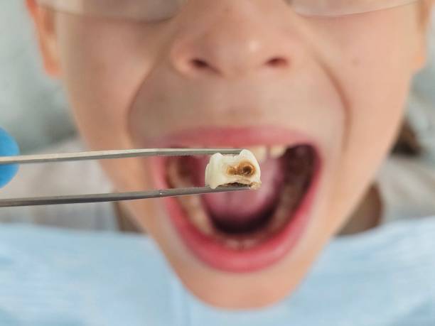 Best Cracked Tooth Emergency Dentist  in Valmeyer, IL